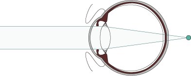 遠視 イラスト